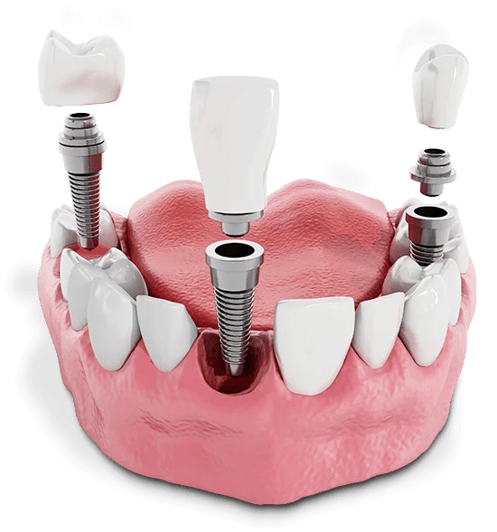 Single Tooth Implants & Bridges are the most lifelike way to replace failing or missing teeth in a localized area. Low Prices – FREE Consultations!
