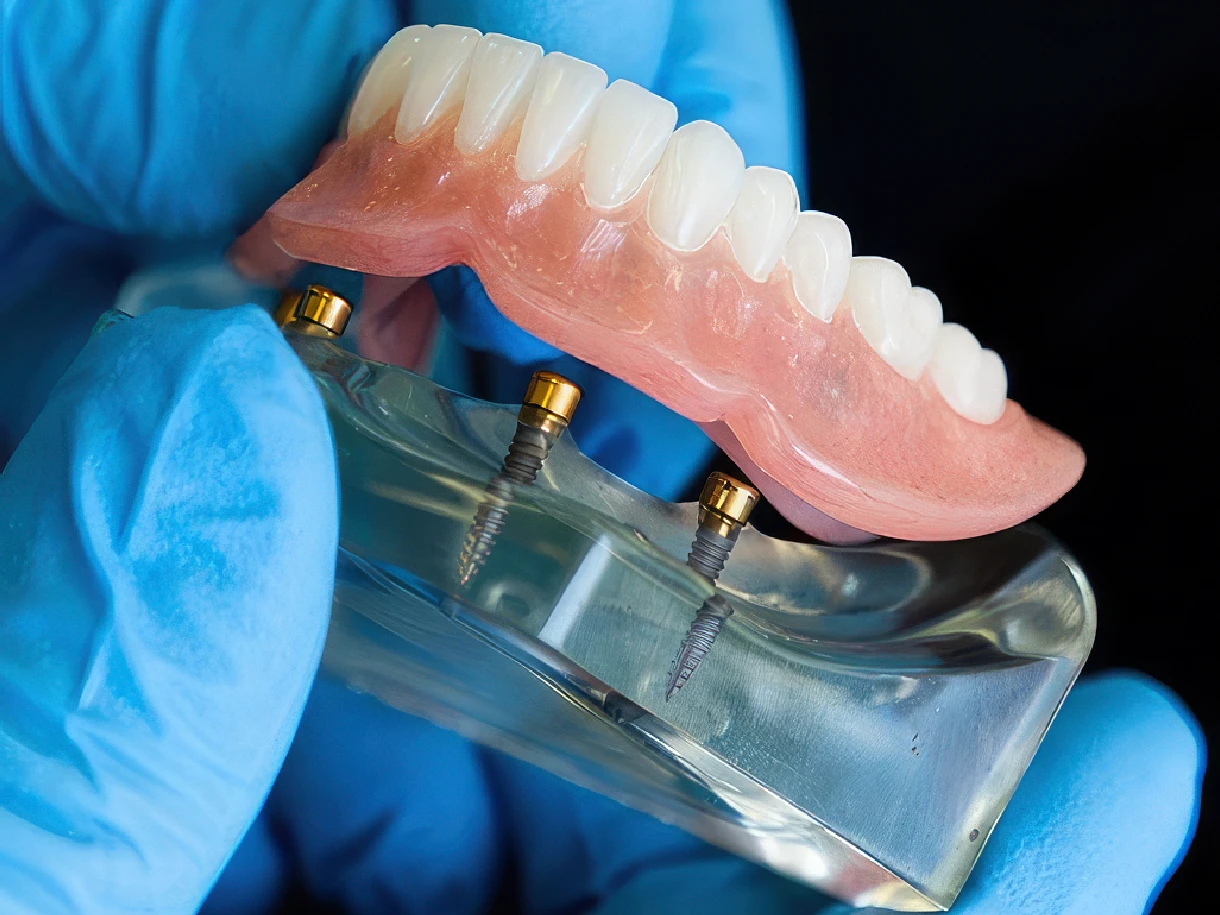 Implant Dentures combine the great look of dentures with the stability and function that you need. Low Prices – 0% Financing Available – FREE Consultations!