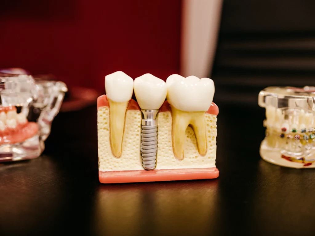 Explore the cost of dental implants in Charlottesville (we're the lowest). 100% Transparent Pricing – 0% Financing Available. FREE Consultations!